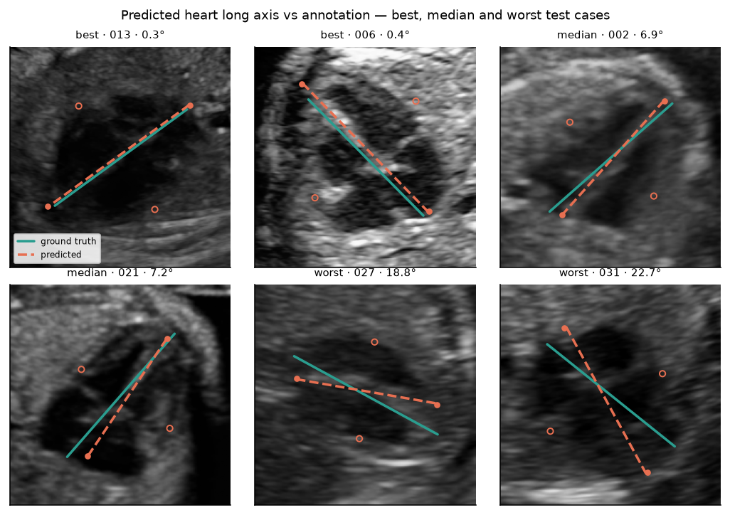 Six fetal four-chamber ultrasound frames with the annotated and predicted heart axes overlaid, labelled best, median and worst